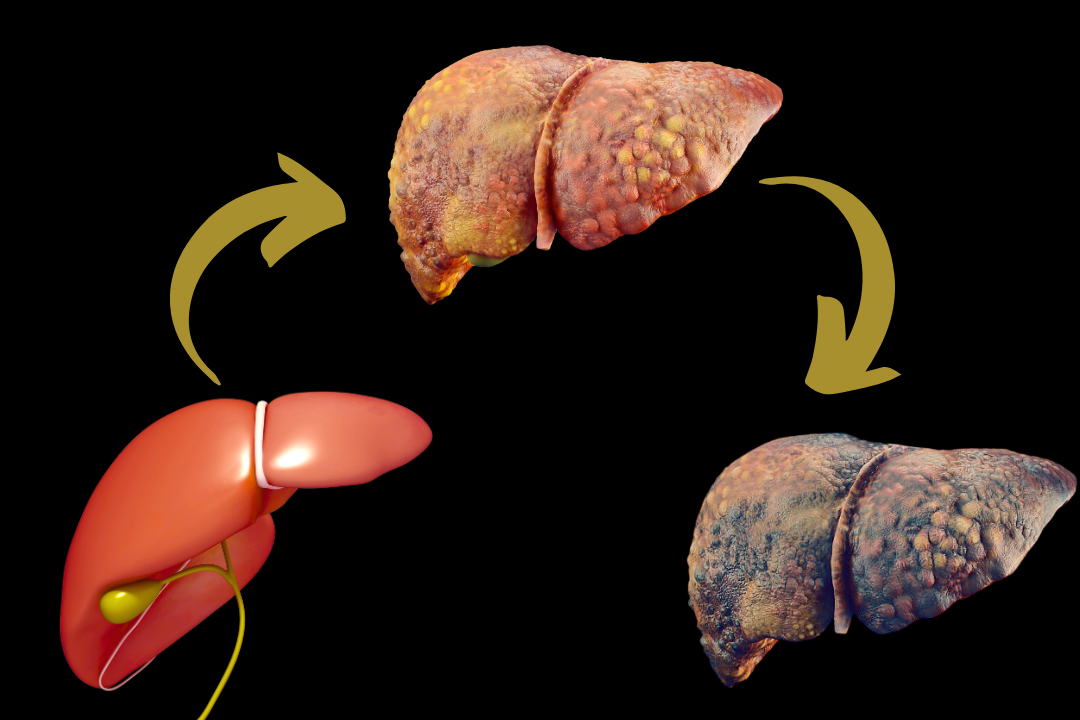 liver cirrhosis