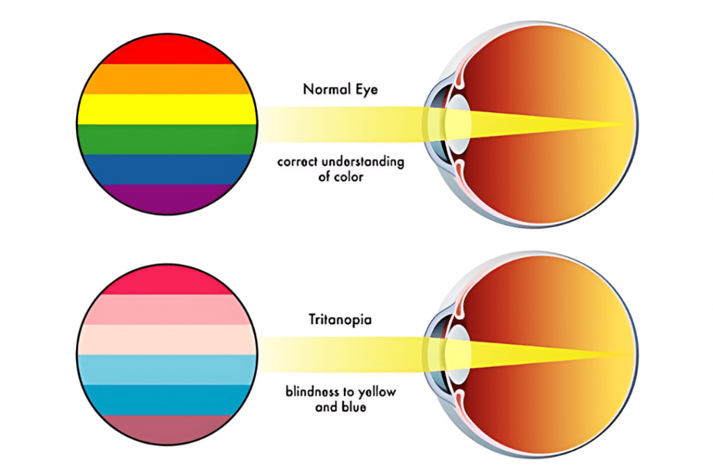 COLOUR BLINDNESS